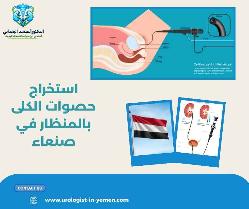 استخراج حصوات الكلى بالمنظار في صنعاء استخراج حصوات الكلى بالمنظار في صنعاء