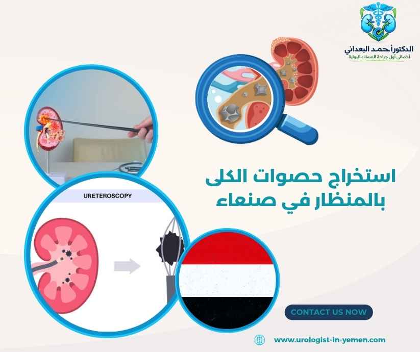 استخراج حصوات الكلى بالمنظار في صنعاء استخراج حصوات الكلى بالمنظار في صنعاء
