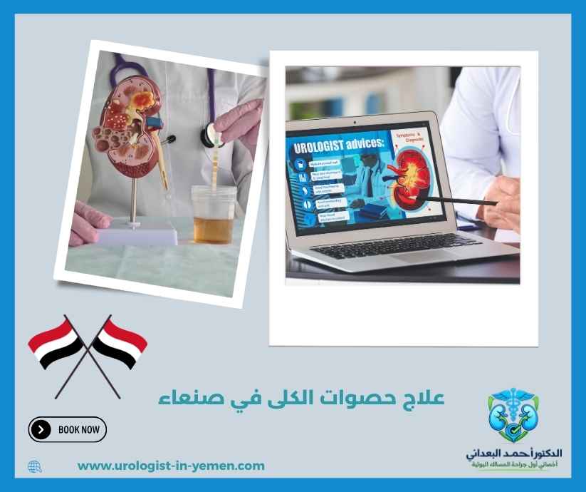 علاج حصوات الكلى في صنعاء