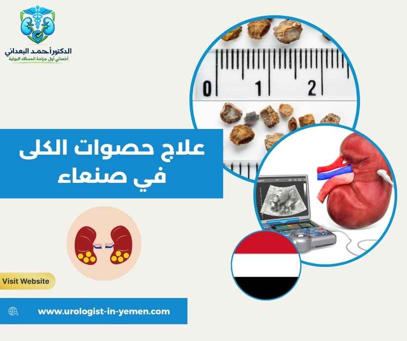علاج حصوات الكلى في صنعاء