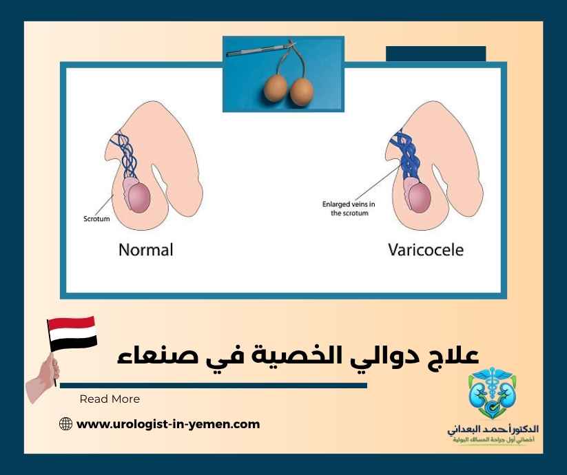 علاج دوالي الخصية في صنعاء علاج دوالي الخصية في صنعاء