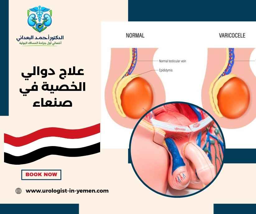 علاج دوالي الخصية في صنعاء علاج دوالي الخصية في صنعاء