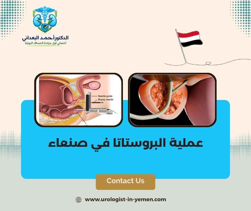 عملية البروستاتا في صنعاء